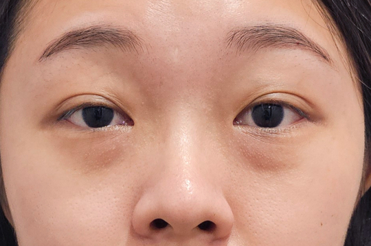 隱痕眼袋手術前的照片Before